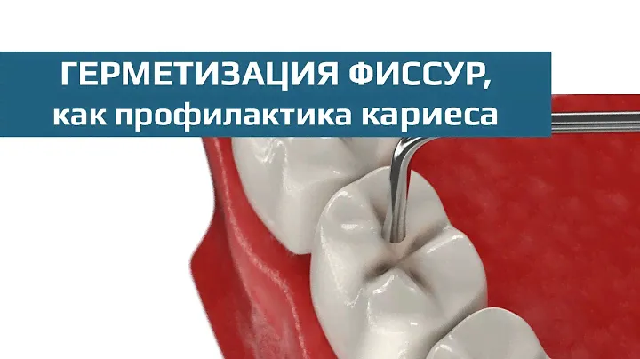 Профилактика кариеса: герметизация фиссур